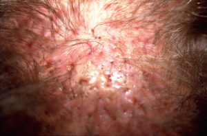 Inflamaciones visibles y tejido cicatricial causado por implantes de cabello artificial en el cuero cabelludo de un hombre visto de cerca
