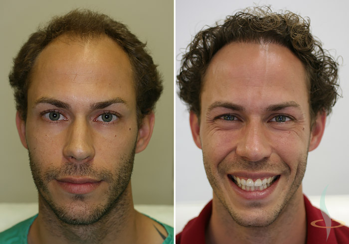 A la izquierda: antes / a la derecha: después de la segunda operación