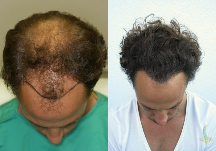 A la izquierda: antes / a la derecha: después de la tercera operación