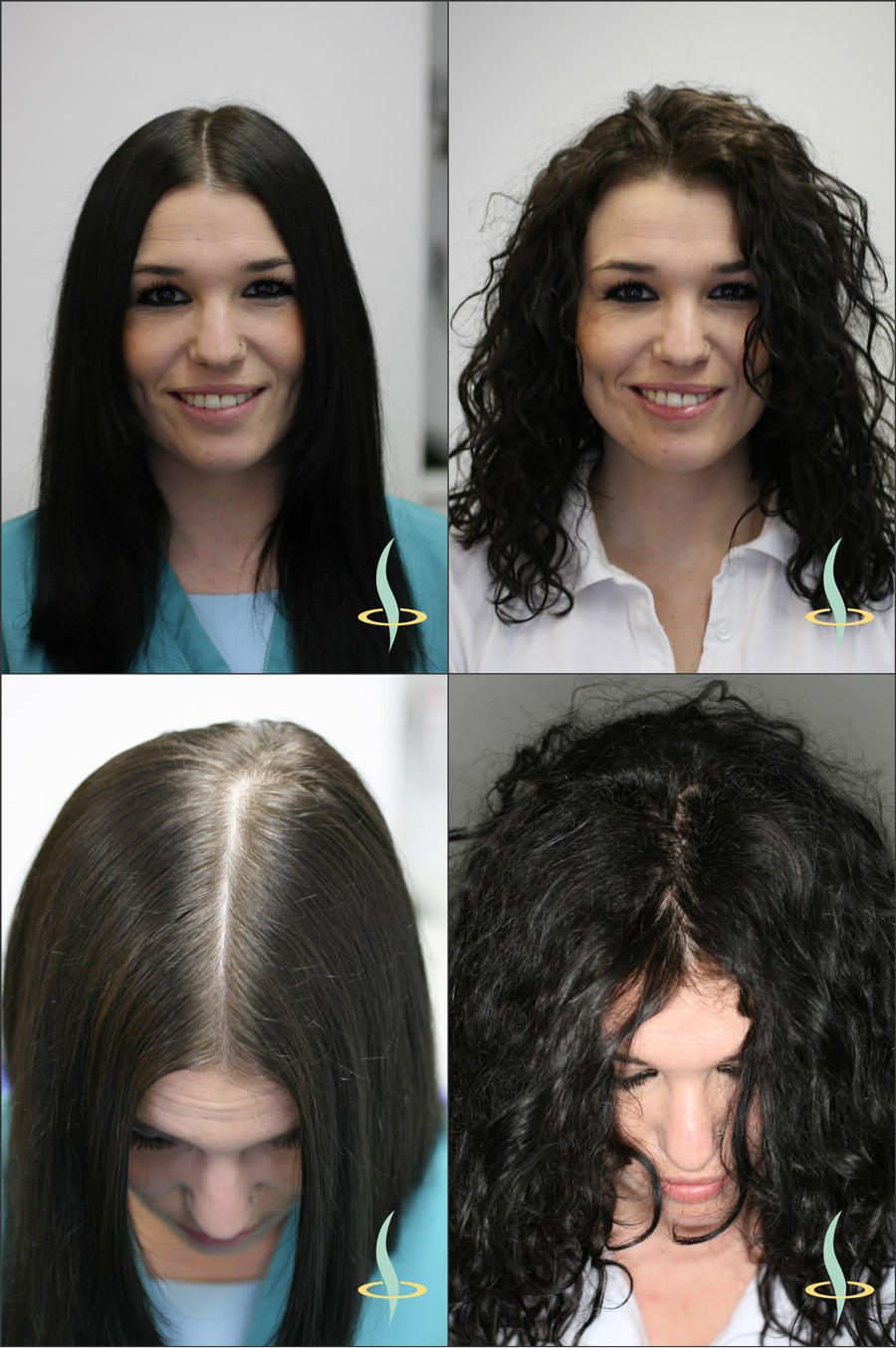 Figura 2: Efecto óptico de la visibilidad del cuero cabelludo en cabello liso (izquierda) y rizado (derecha). (Fuente: representación propia)