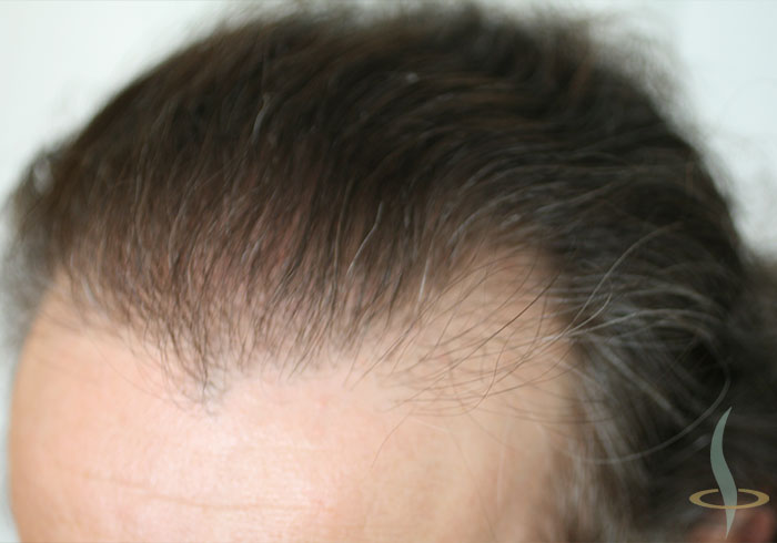 Línea de cabello a la izquierda después de la segunda operación.