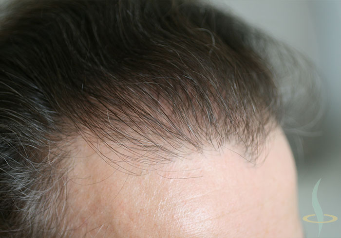 Línea de cabello a la derecha después de la segunda operación.