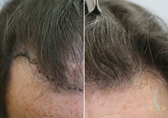 Antes y después de la 2.ª operación