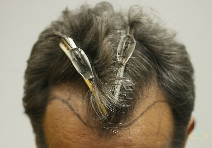 Antes de la intervención (con línea capilar)