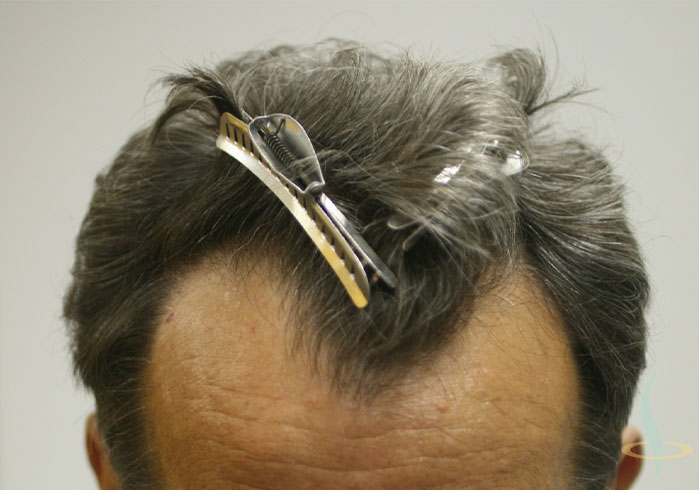 Antes de la intervención